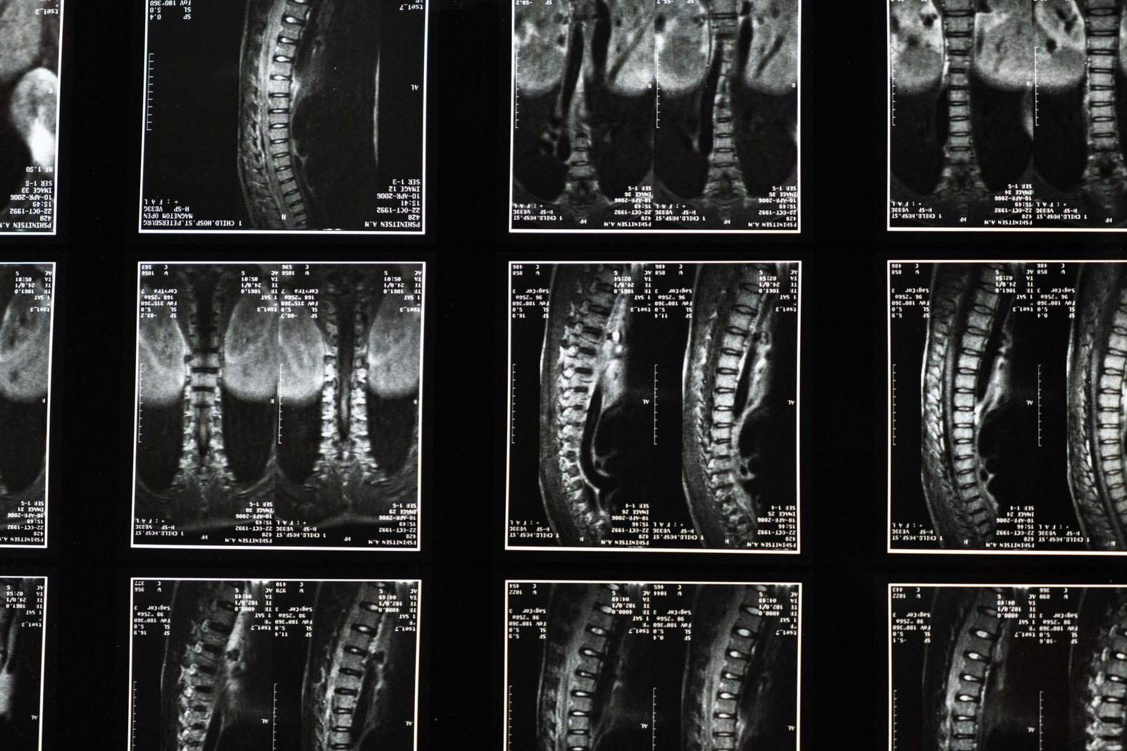 An anatomical model of the cervical spine showing the discs and the nerve root exits