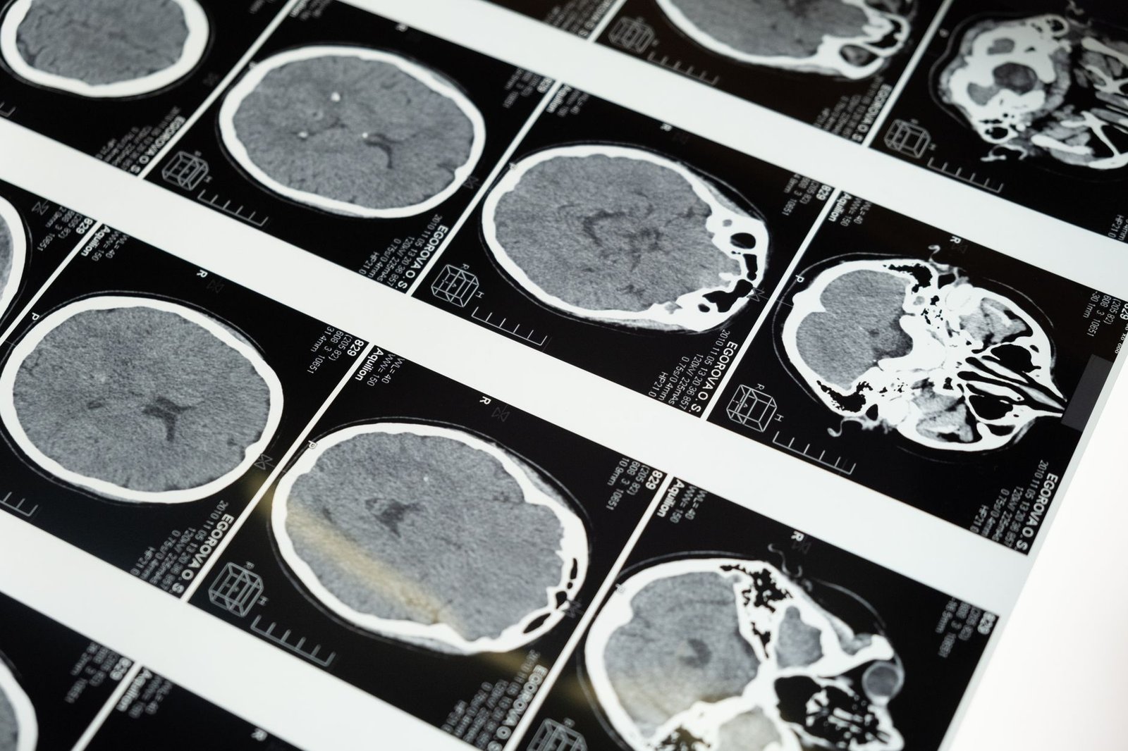 Cervical spine MRI images displayed for review, showing the age-related change common on normal scans