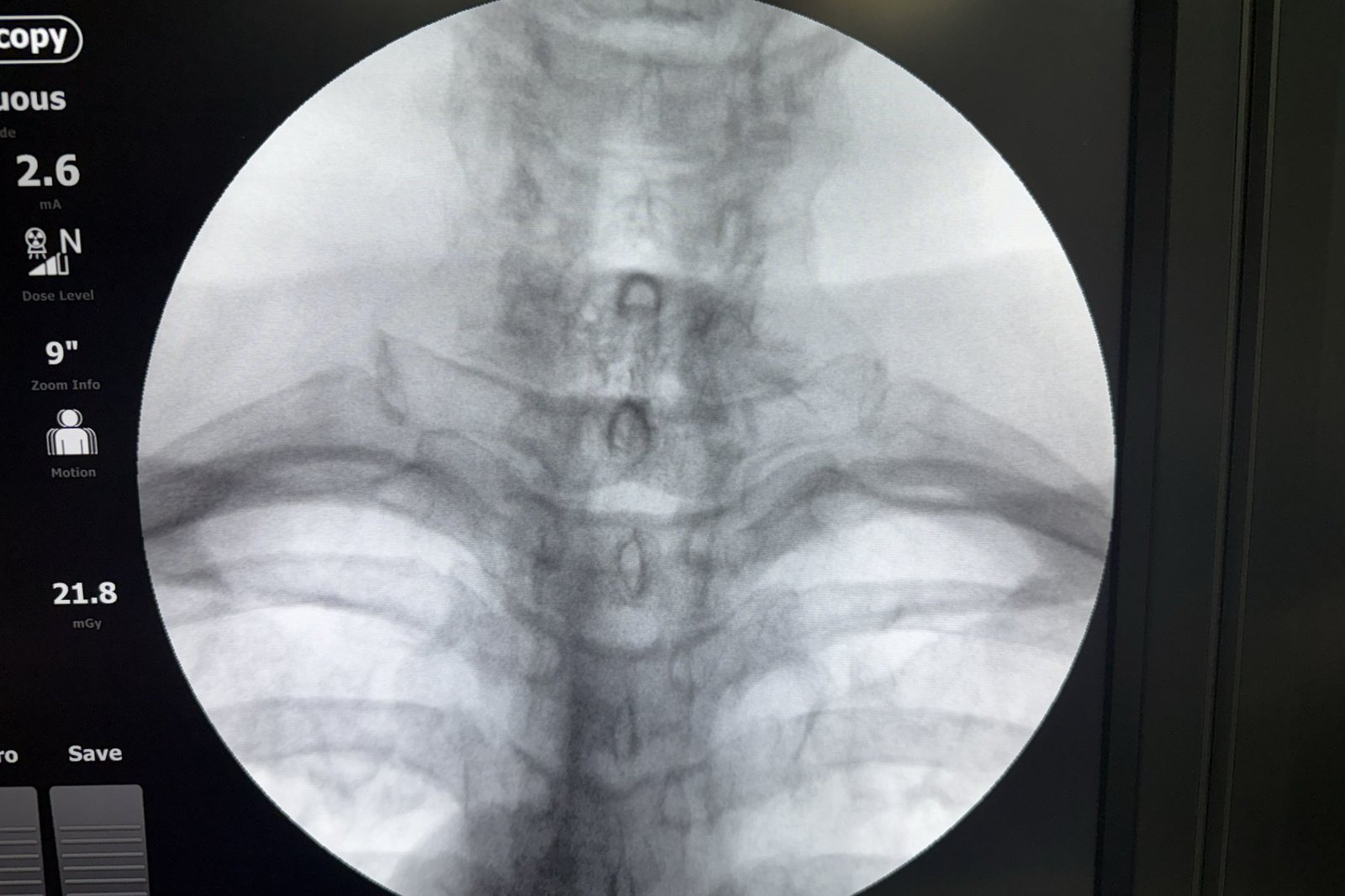 Fluoroscopic image of the cervical spine showing degenerative disc disease with loss of disc height.