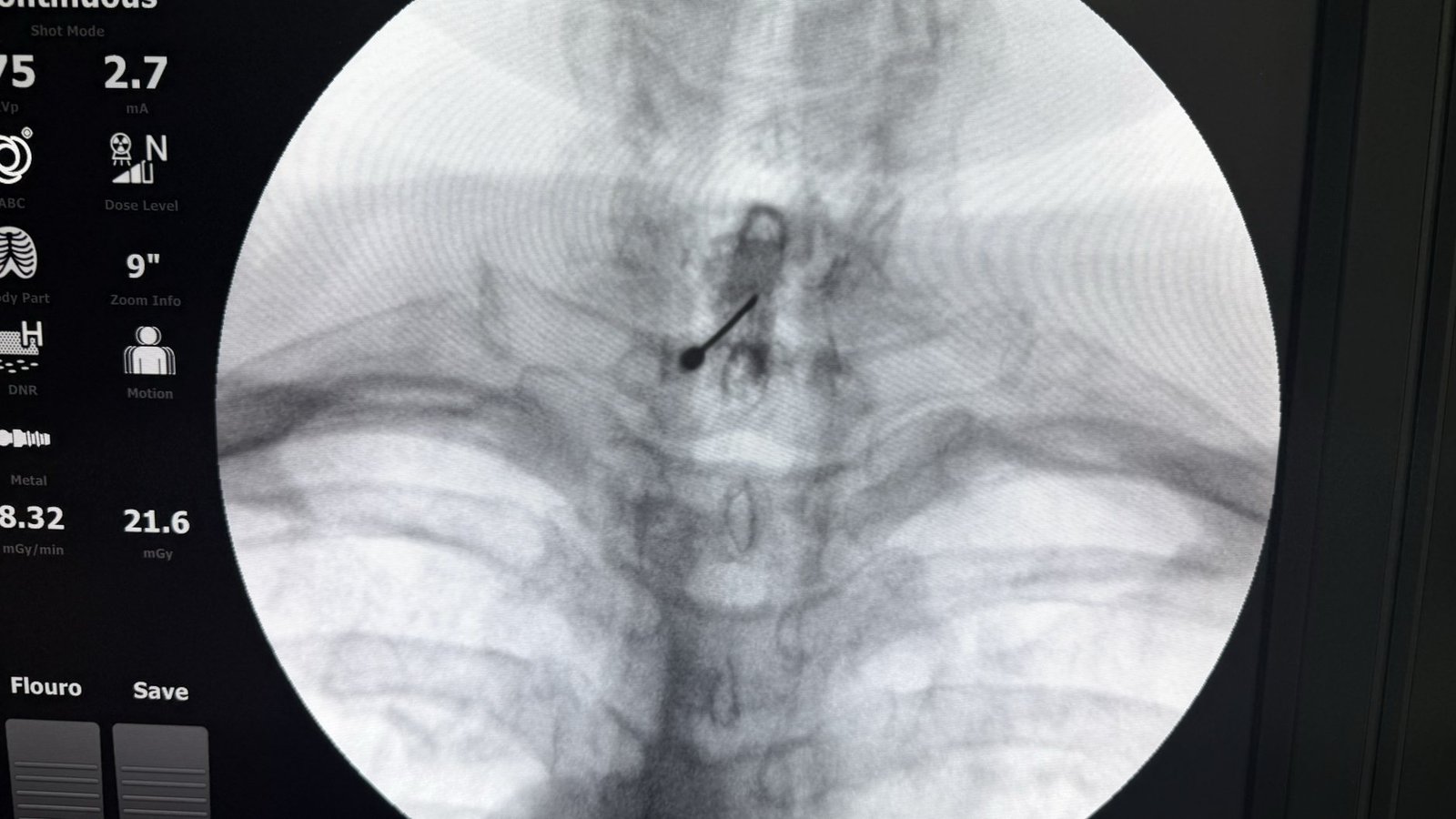 Live fluoroscopy of a cervical epidural steroid injection, contrast outlining the epidural space at the base of the neck.