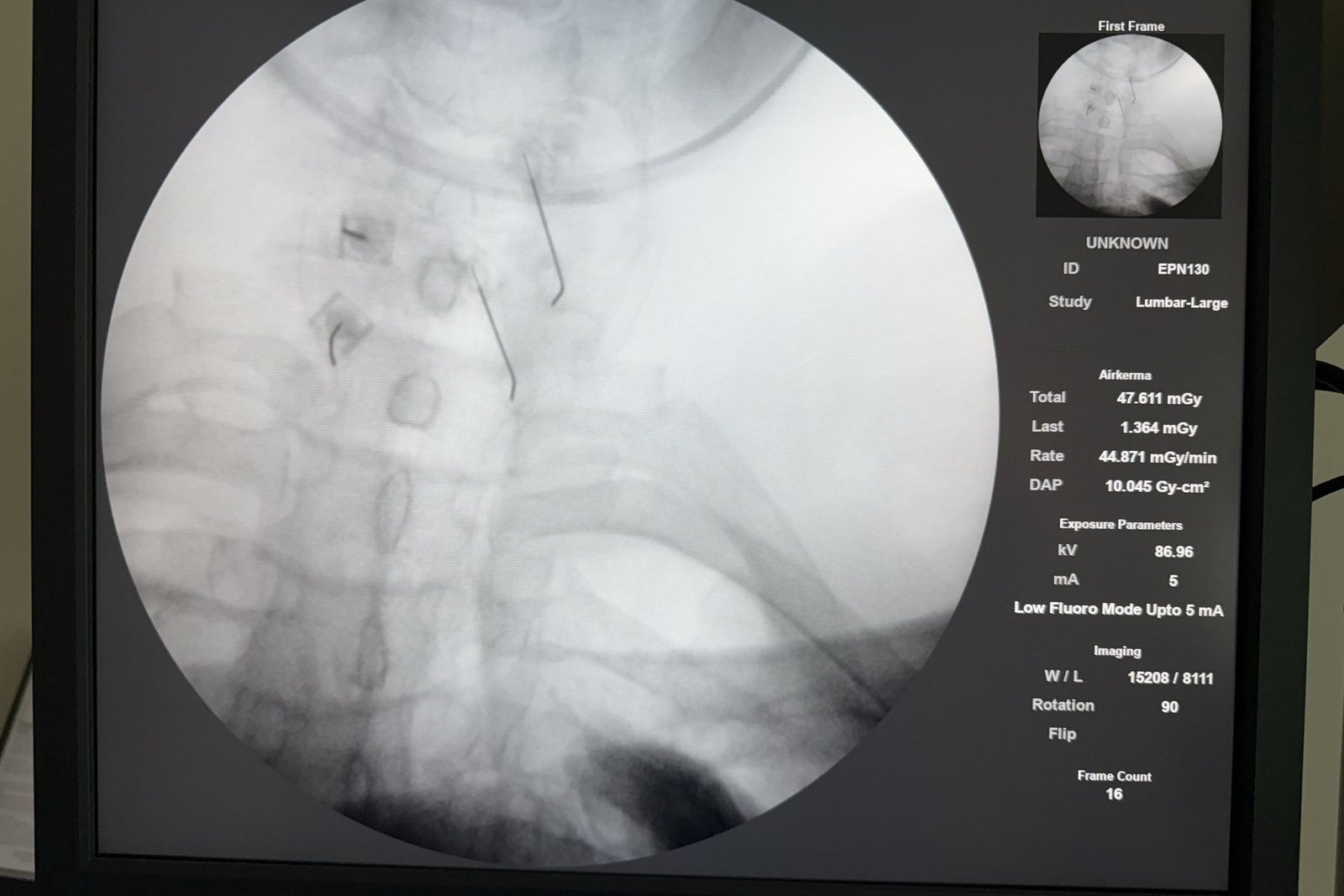Fluoroscopic view of the cervical spine with needles positioned at the cervical facet joints.