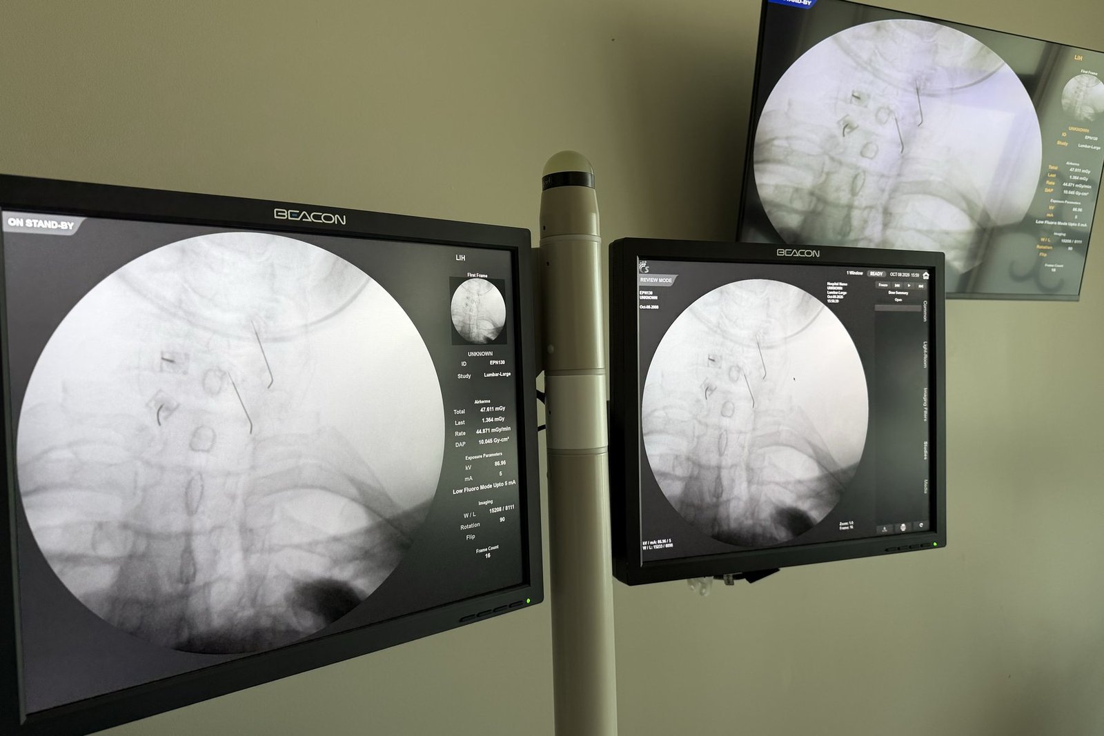 Fluoroscopy monitors in our procedure suite showing needles placed on both sides of the cervical spine for a bilateral cervical medial branch block.