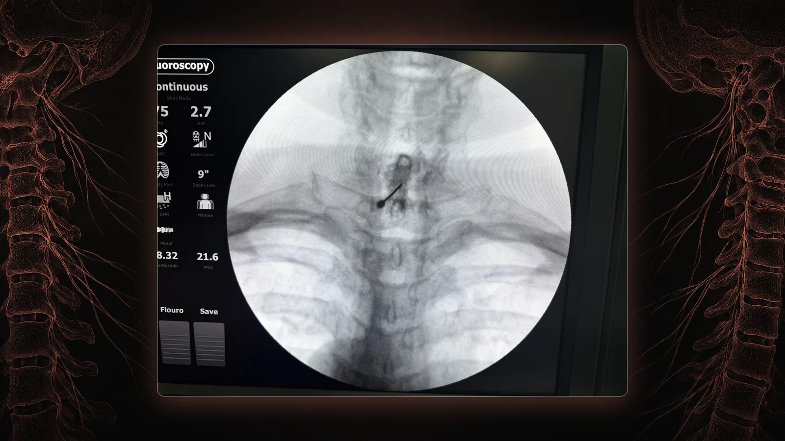 Live fluoroscopy of a cervical epidural steroid injection, contrast outlining the epidural space at the base of the neck.