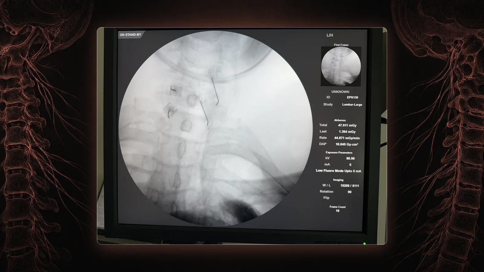 Fluoroscopy of the cervical spine with needles positioned at the cervical facet joints.