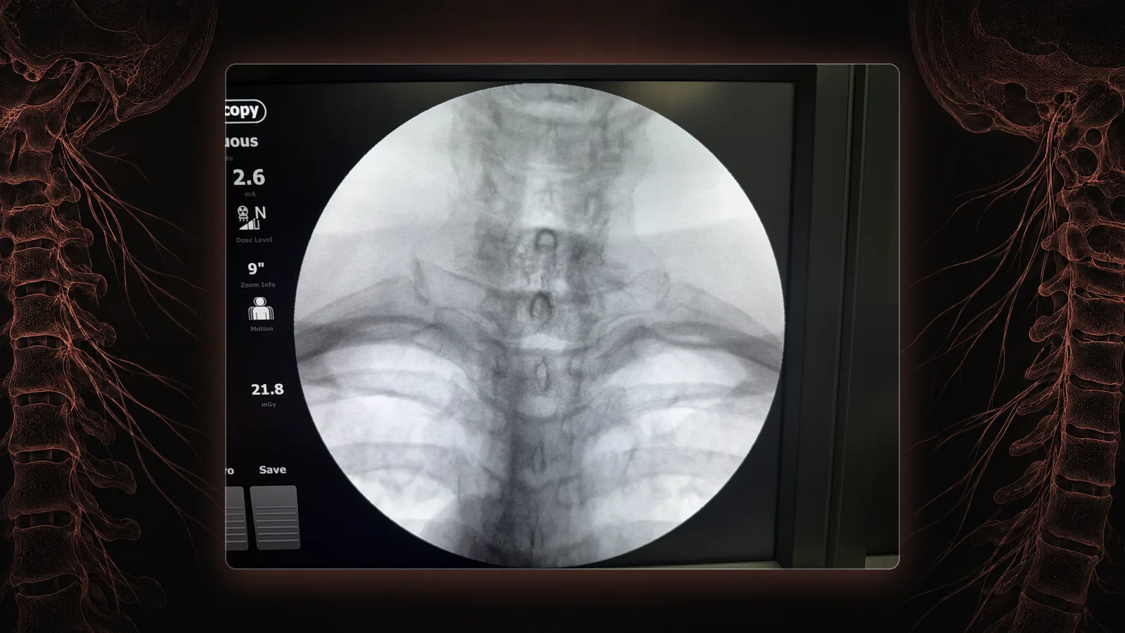 Fluoroscopy of the cervical spine showing degenerative disc disease with loss of disc height.
