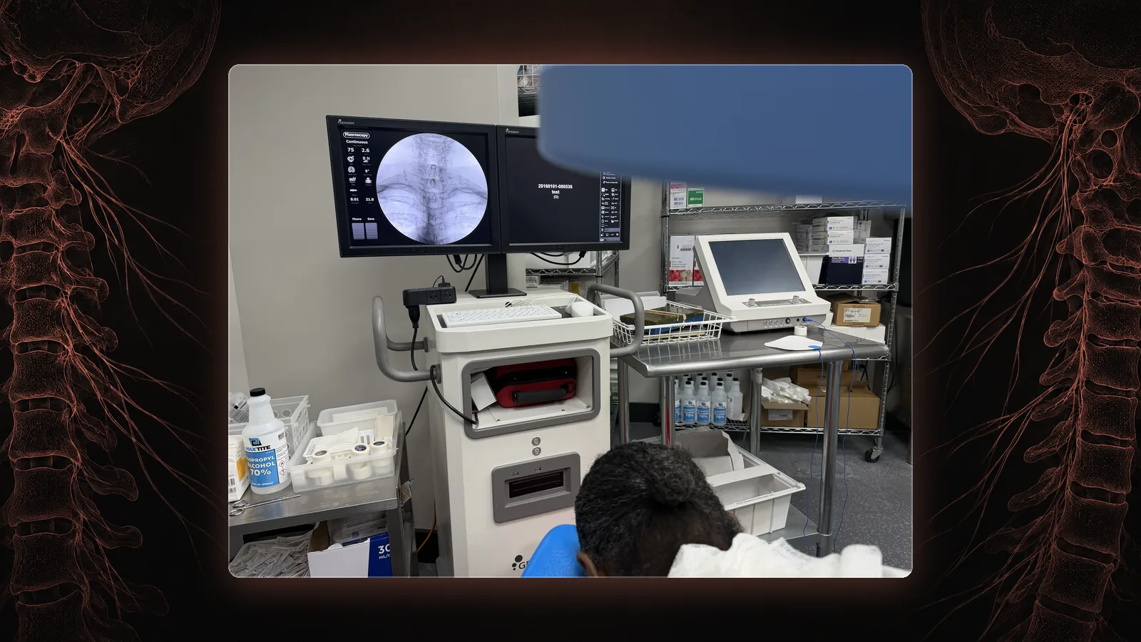 A patient positioned for a cervical epidural steroid injection in our St. Louis procedure suite, the fluoroscopy monitor showing the cervical spine.